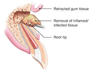 apicoectomy