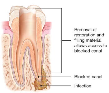 canal diagram