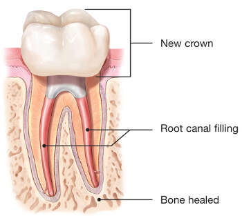 retreatment root canal crown