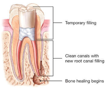temporary root canal diagram