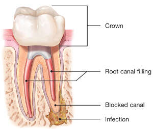 retreatment root canal diagram
