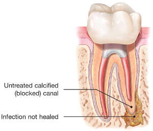 tooth abscess diagram