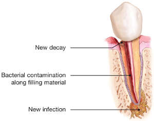 tooth infection diagram