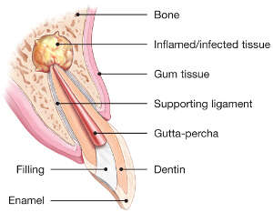 endodontic surgery explained