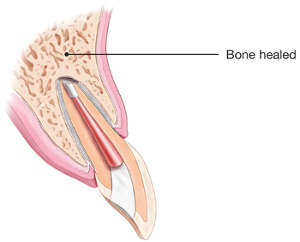 endodontic surgery healed