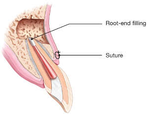 endodontic surgery root end filling