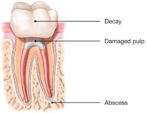 root canal damaged pulp